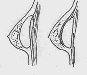 Posizionamento della protesi retro-ghiandolare e sotto muscolo pettorale